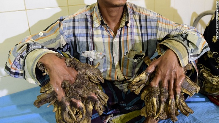 Bangladesh`s `Tree man` has his hands back